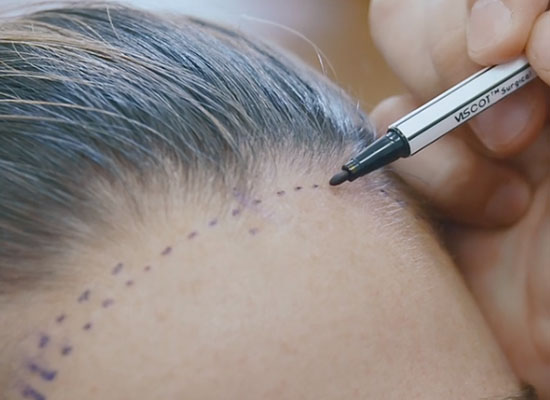 Forehand being marked with pen for hair transplant