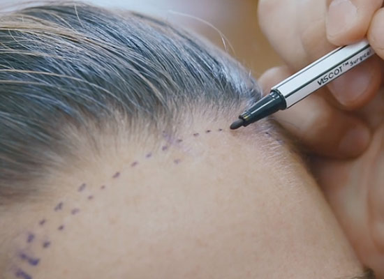Microscope greffe de cheveux